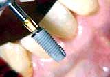 titanium dental implant